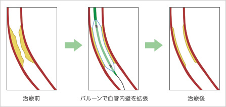 バルーン形成術 イメージ図