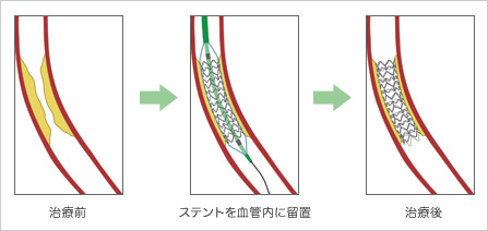 ステント留置術 イメージ図